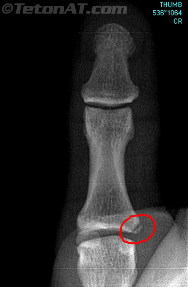 skiers-thumb-x-ray